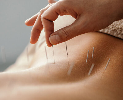 Link to: /programs/acupuncture
